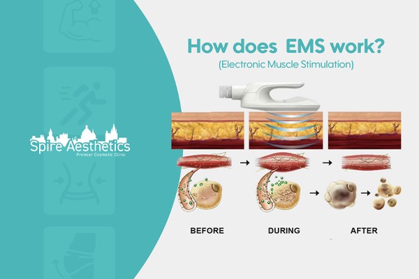 EMS treatment for post pregnancy weight loss treatment Greenock
