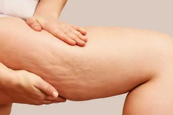 Image of woman showing leg with cellulite Greenock