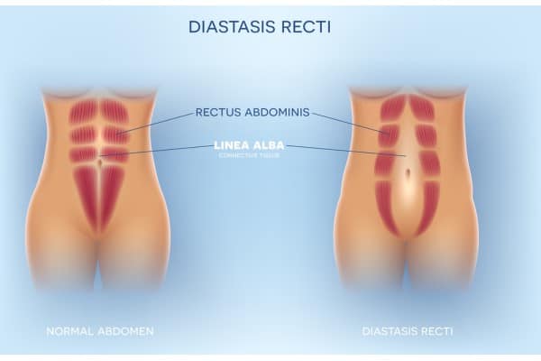 How Does Non-Surgical Treatment Help With Loose Skin, Weak Abdominal Muscles and Post-Pregnancy Changes Greenock?