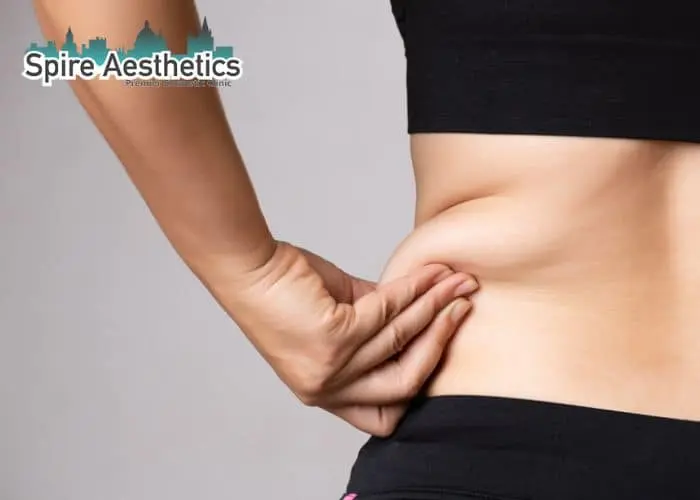 Image of woman pinching fat on their hips Greenock. Fat Freezing treatment