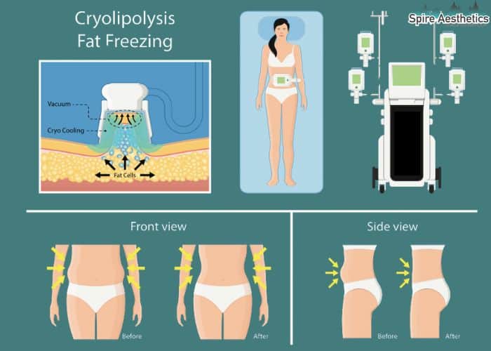 Image of diet and fat freezing combined for best results for Spire Aesthetics Greenock