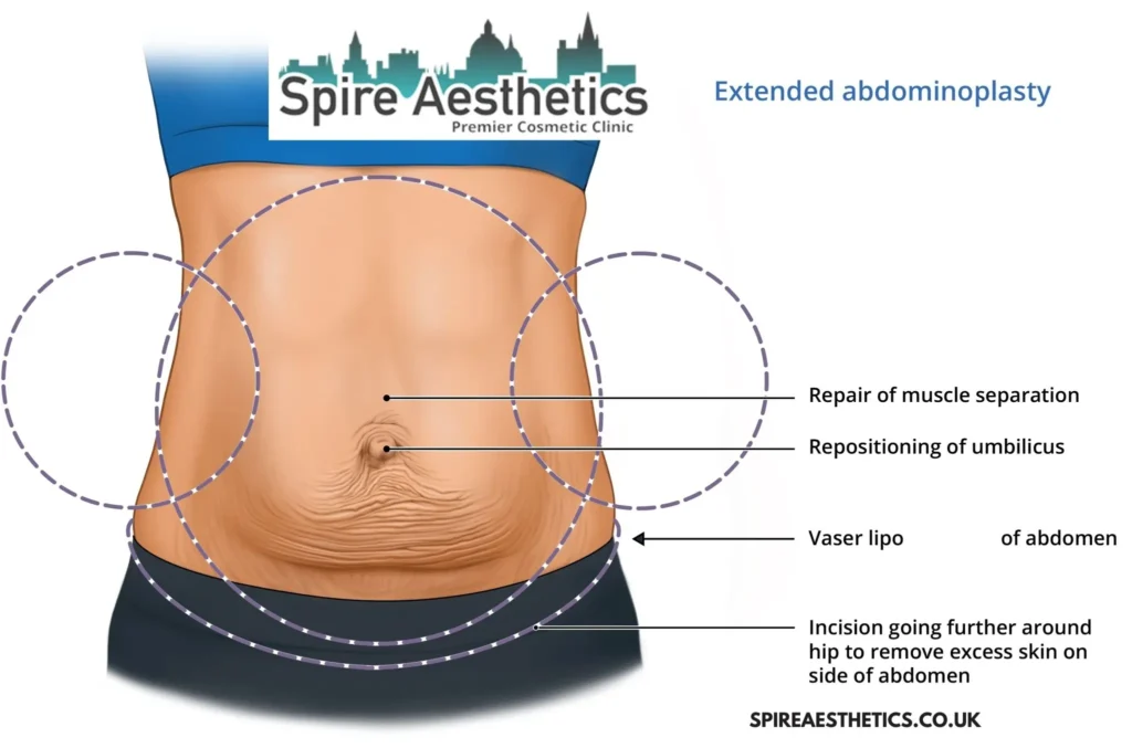 Understanding Loose Skin After Gastric Band Greenock Surgery and HIFU Treatment