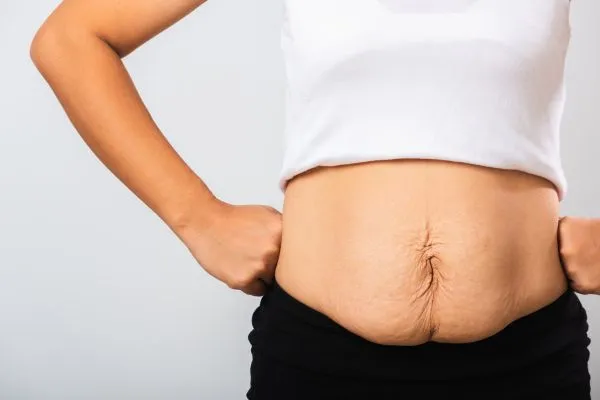 Image of a woman's stomach after weight loss with sagging skin following a gastric band Greenock
