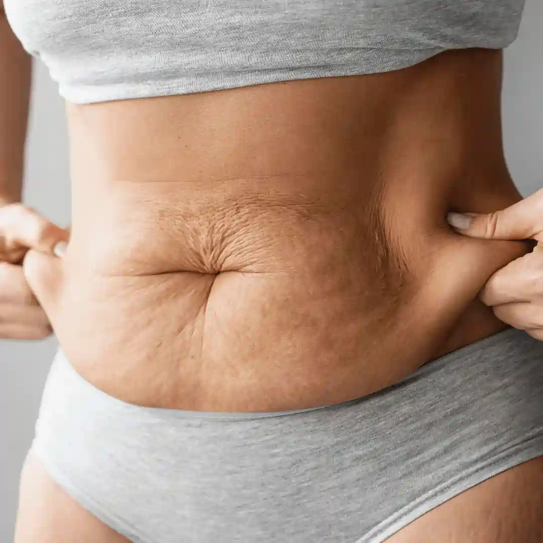 Is It Normal to Have Loose Skin After Pregnancy Greenock?