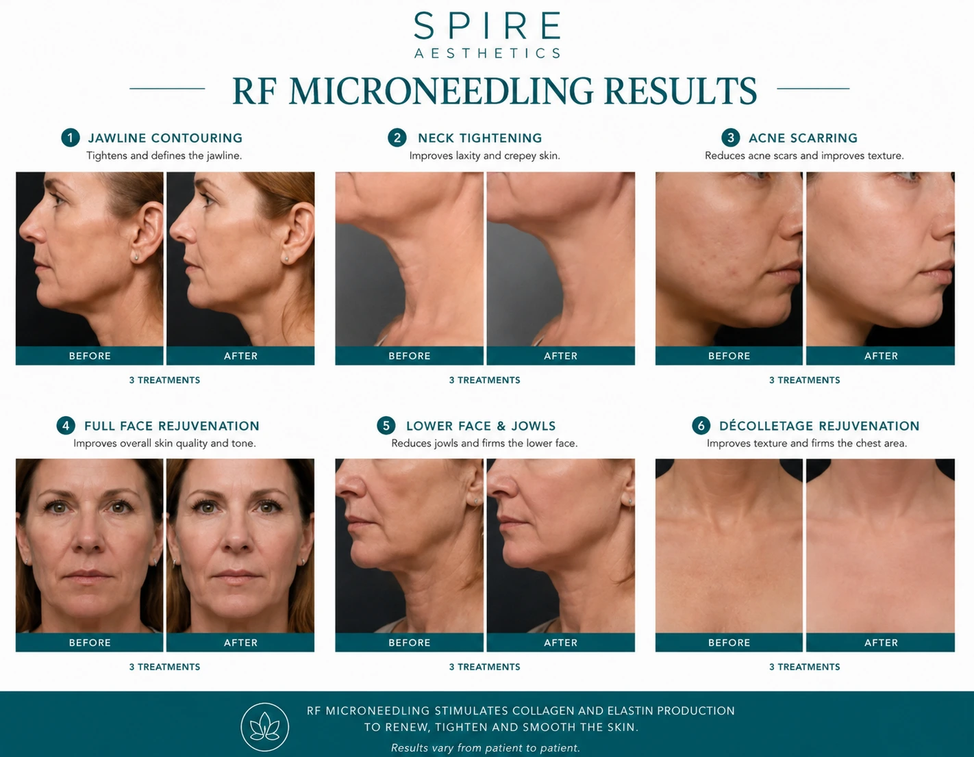 RF Microneedling Skin tightening Greenock results