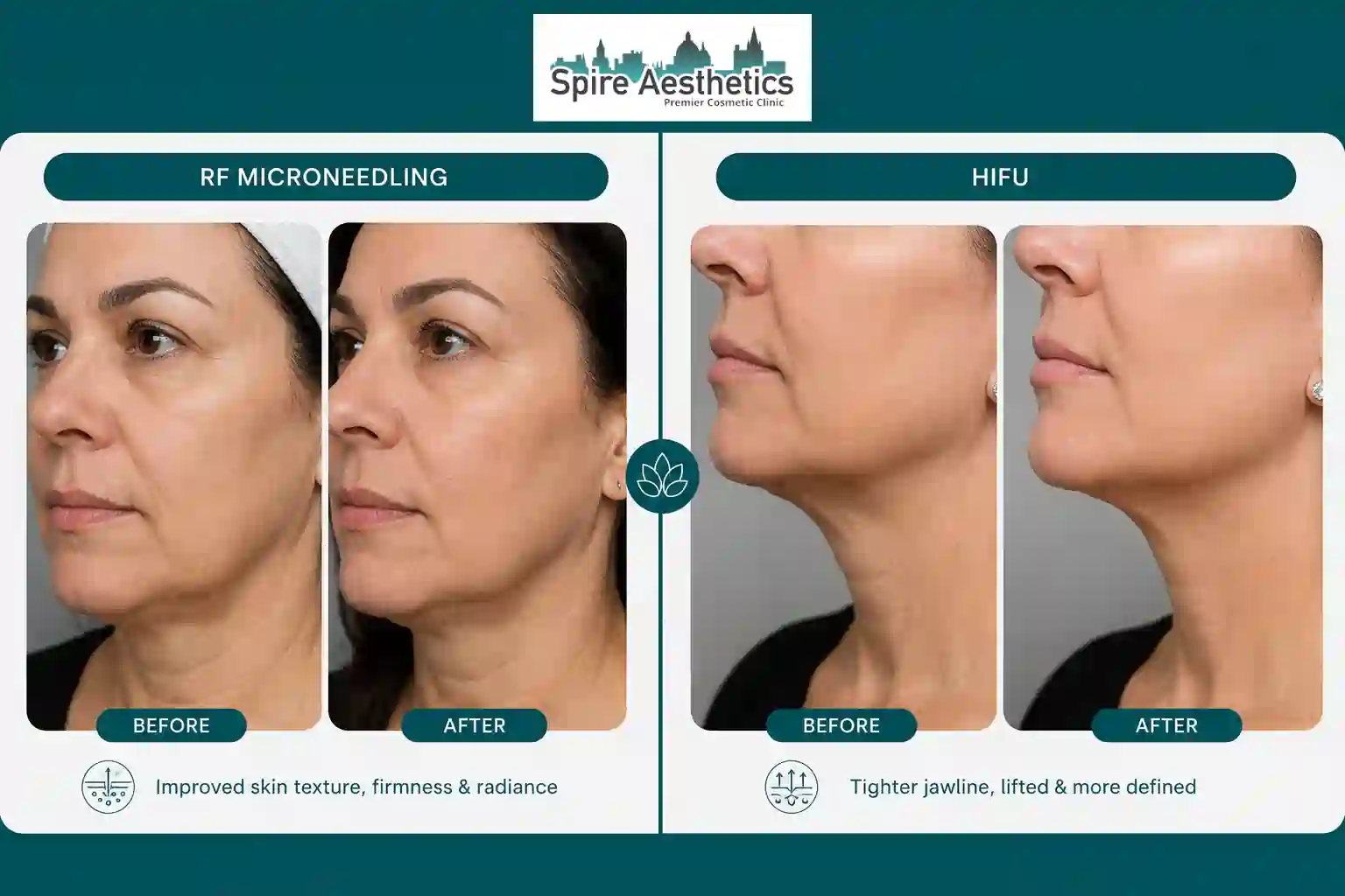 Can RF Microneedling and HIFU Be Combined Greenock?